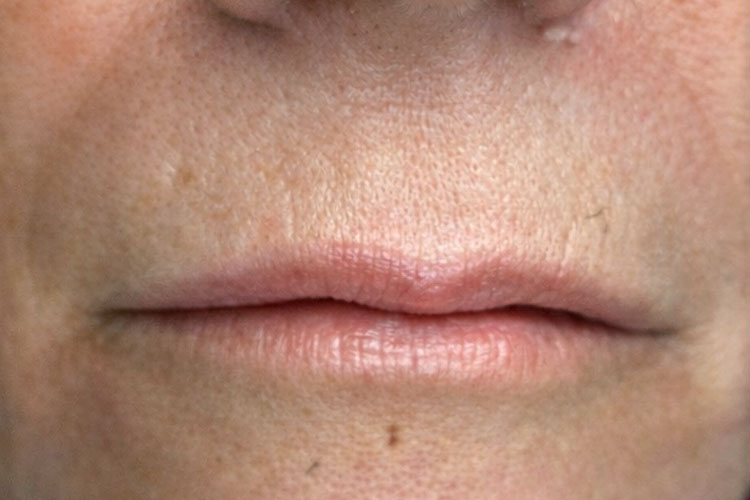 Dermal Filler: Lips Treatment (before image)