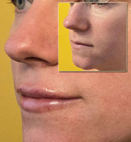 Dermal Diller Lips Treatment