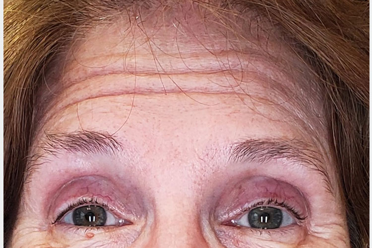 Forehead & Crows Feet - Botox Treatment (before)