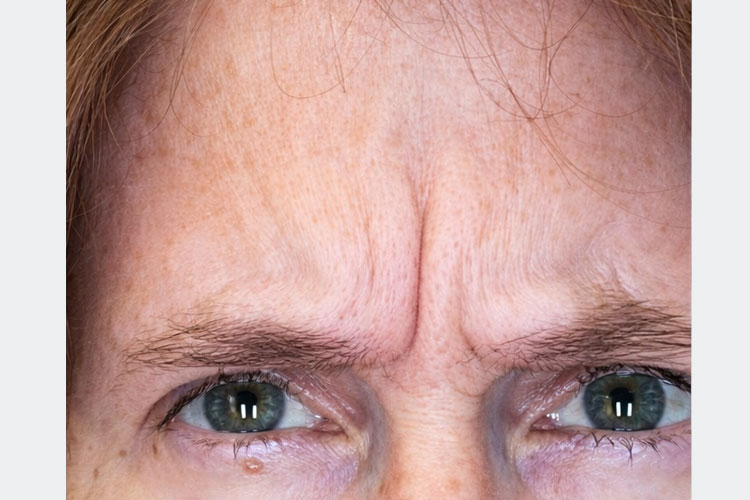 Frown Lines (Botox Treatment) - Before Image