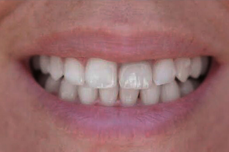 Invisalign Treatment in an Adult - After Picture