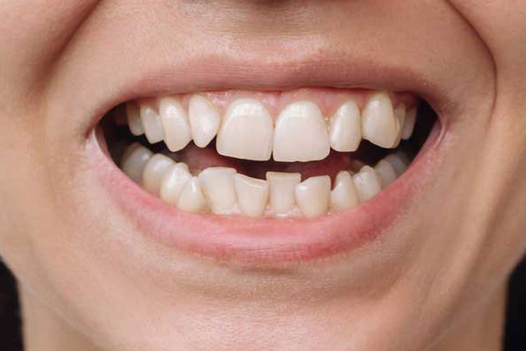 Invisalign Treatment - Before Picture