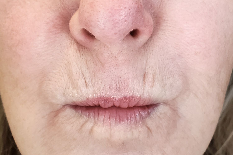 Lips Treatment Before