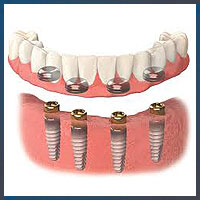 Over Dentures Implant
