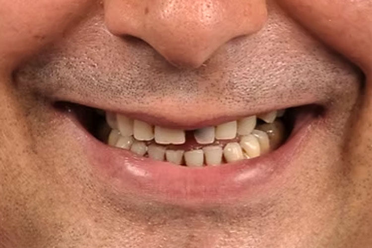 Single Tooth Implant -Before Image
