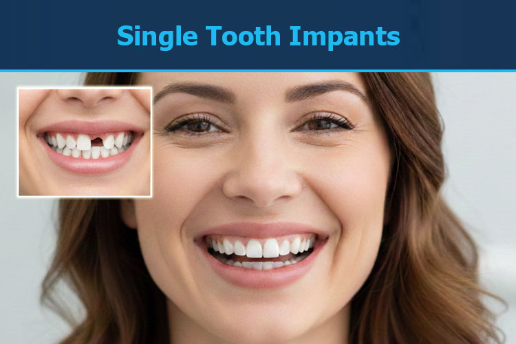 Single Tooth Implants