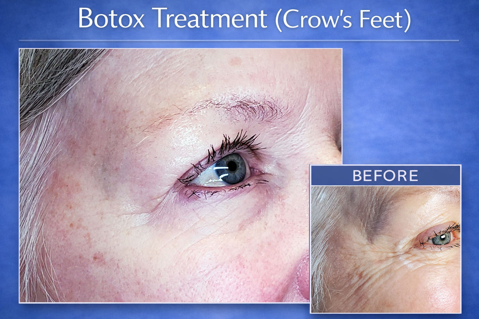 Botox Treatment (Crow's Feet)