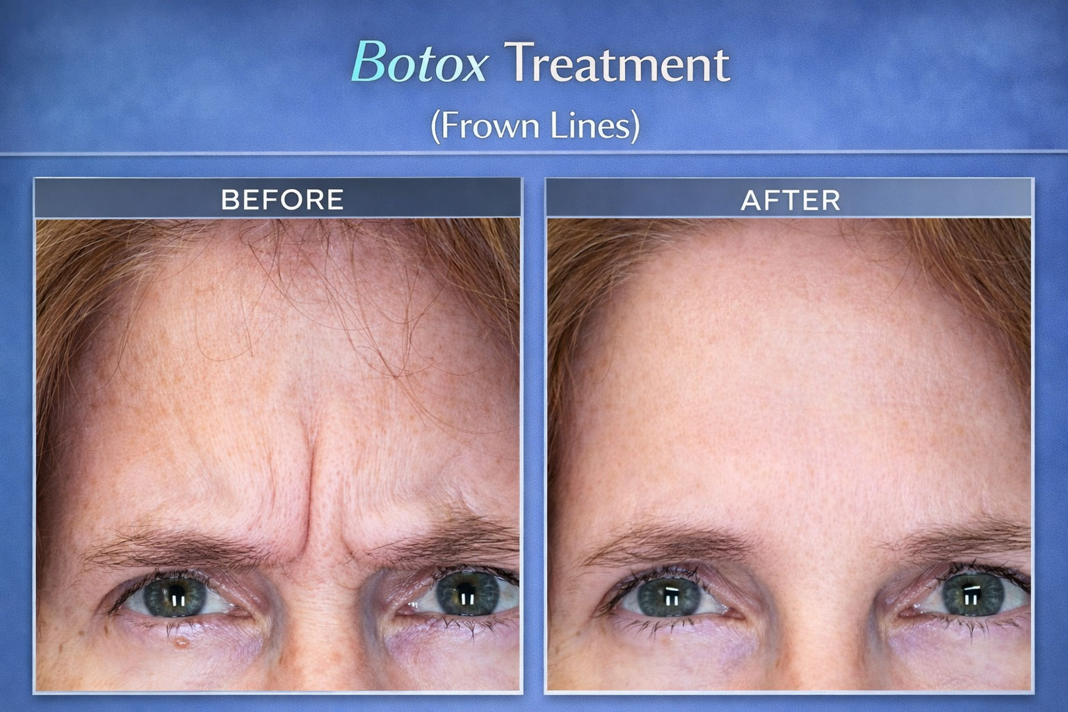 Botox Treatment (Frown Lines)