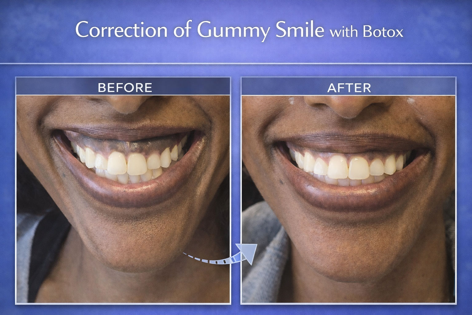Correction of Gummy Smile with Botox