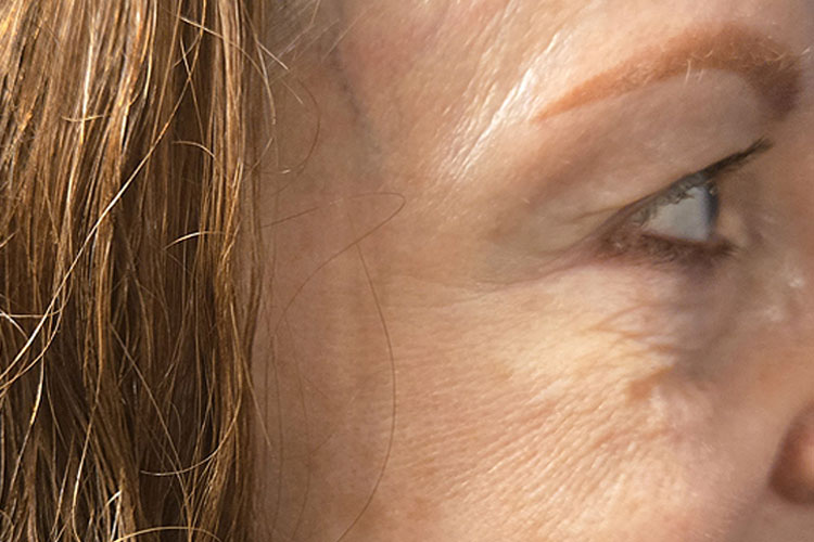 Crow's Feet - After Image