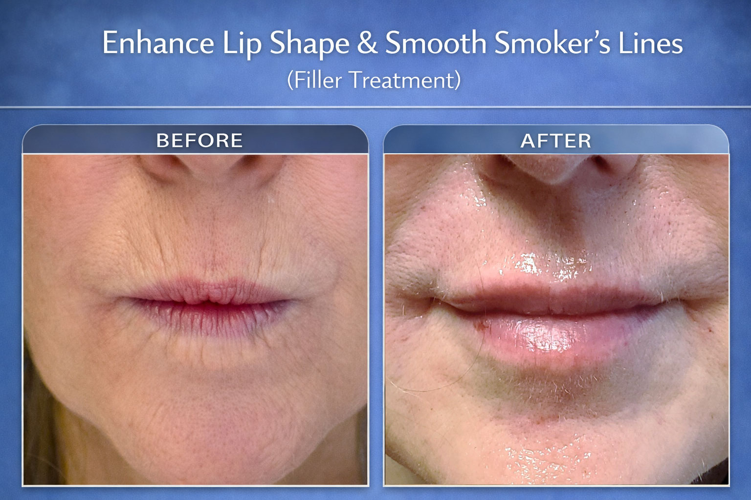 Filler Treatment: Lips & Smoker Lines