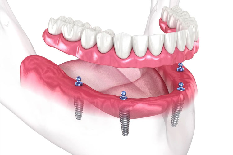 Full Arch Implant (All-On-4)
