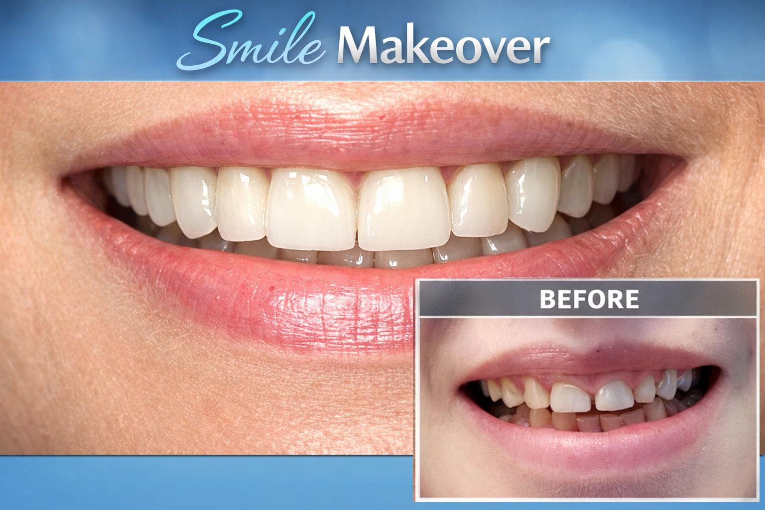 Smile Makeover