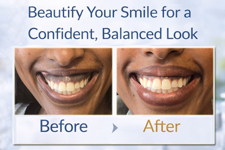 Botox Treatment of Gummy Smile