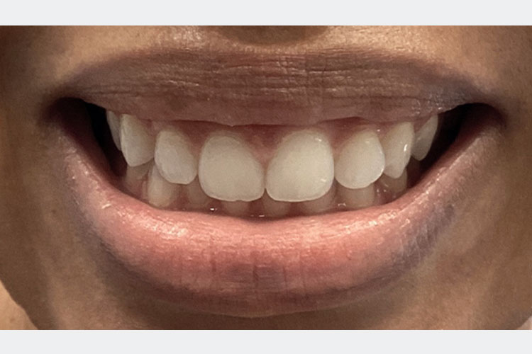 Gummy Smile Treatment With Botox (After Image)