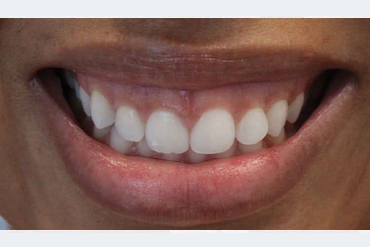 Gummy Smile Treatment With Botox (Before Image)