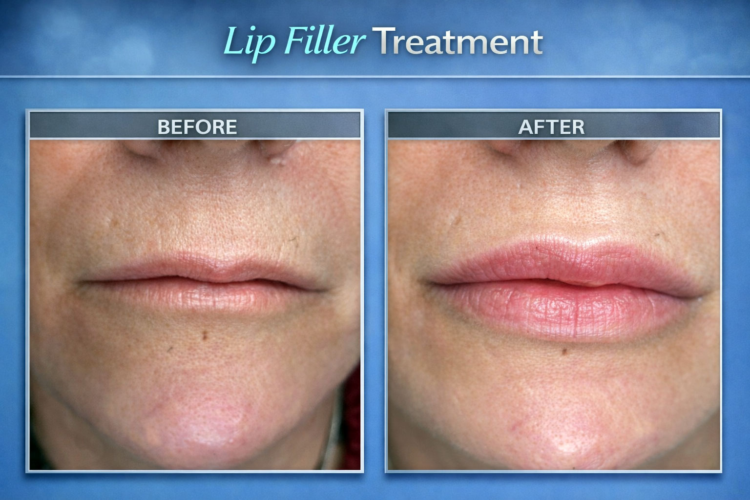 Lip Filler Treatment