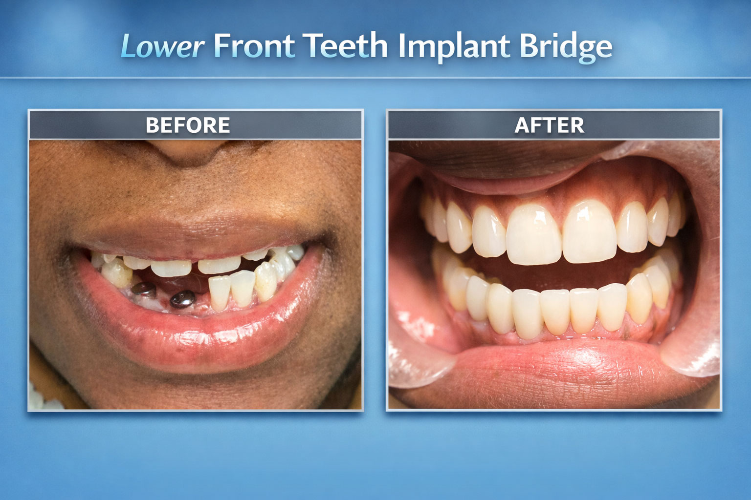 Lower Front Teeth Implant Bridge