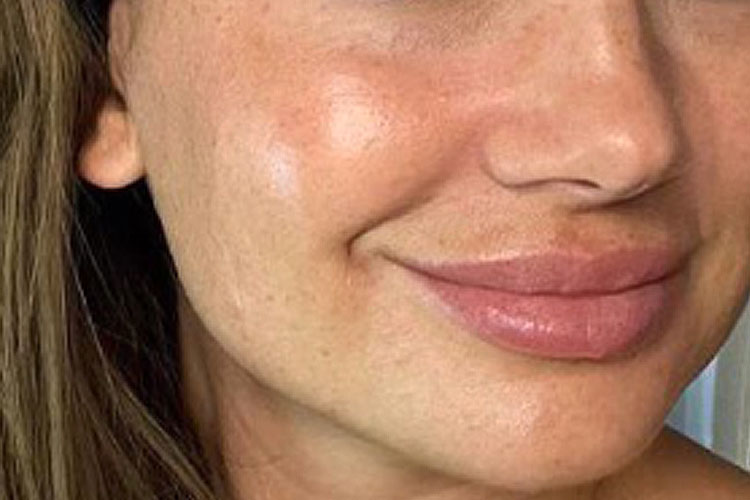 Botox Treatment of Smile Lines - Before Image