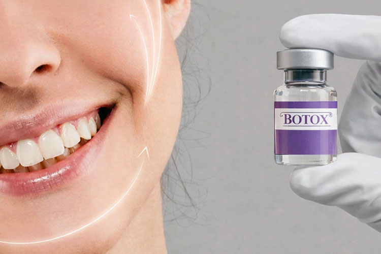 Botox Treatment of Smile Lines