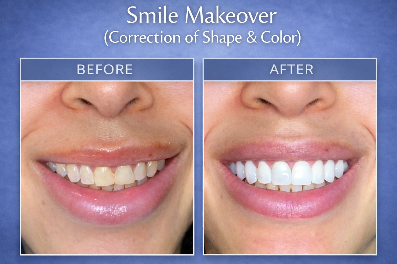 Smile Makeover(Correction of Shape and Color of Teeth)