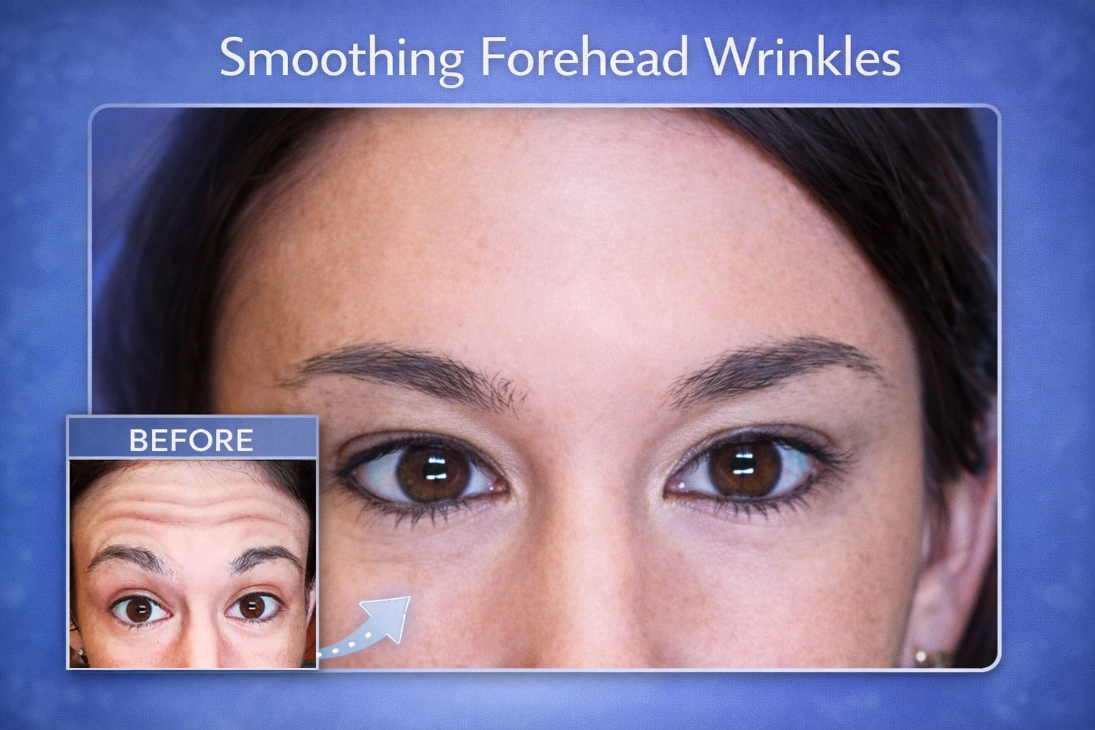 Smoothing Forehead Wrinkles