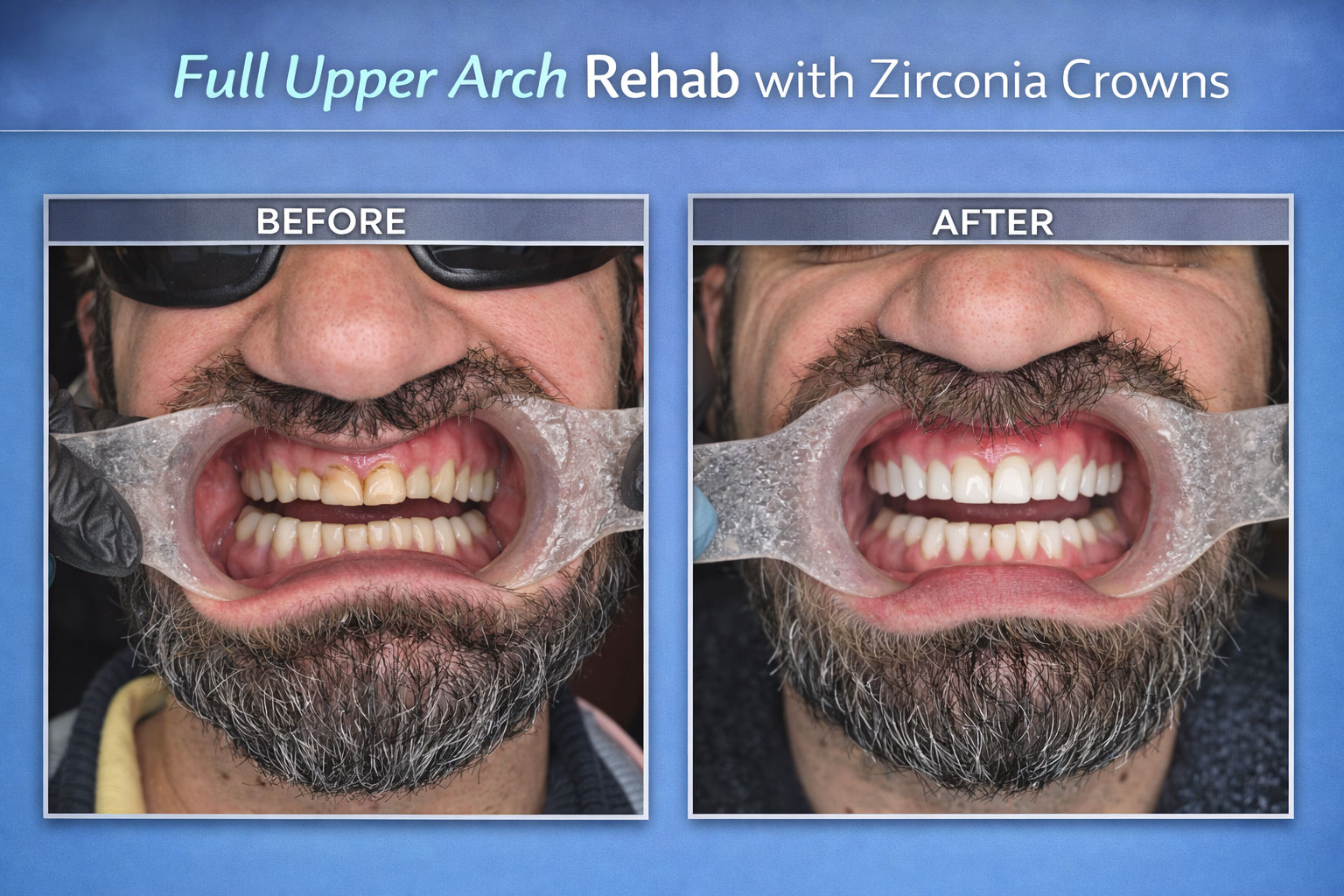 Full Upper Arch Rehab with Zirconia Crowns