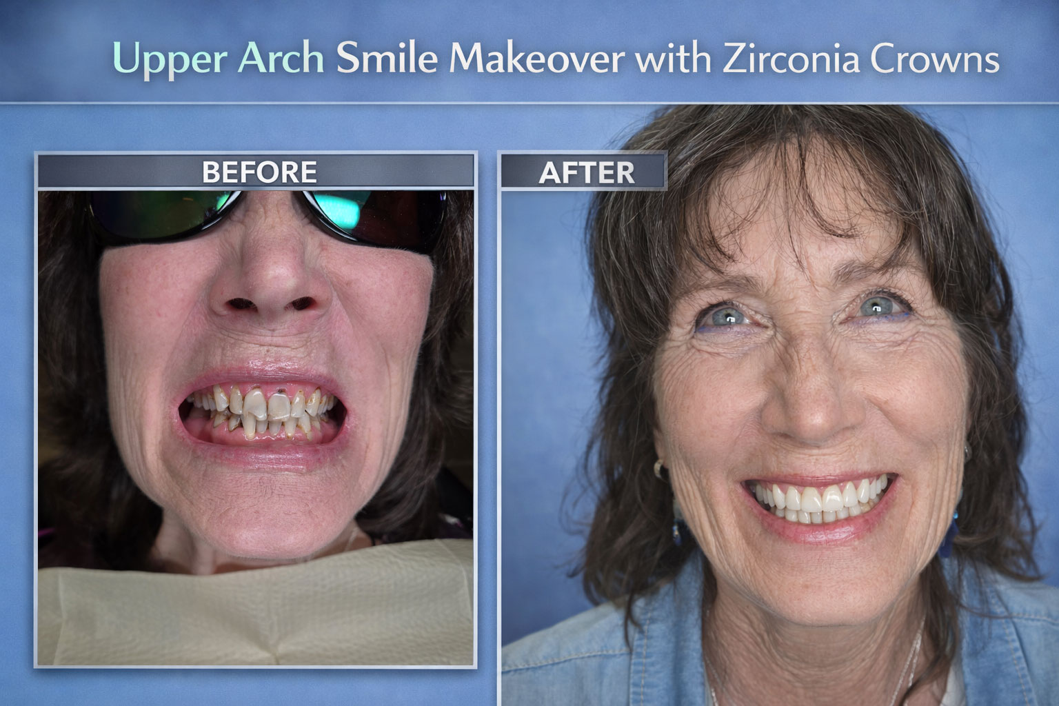 Smile Makeover With Zirconia Crowns