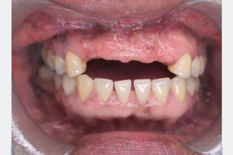 Upper Dental Bridge Implant (before image)