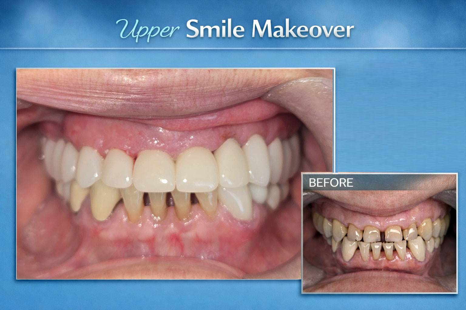 Upper Smile Makeover