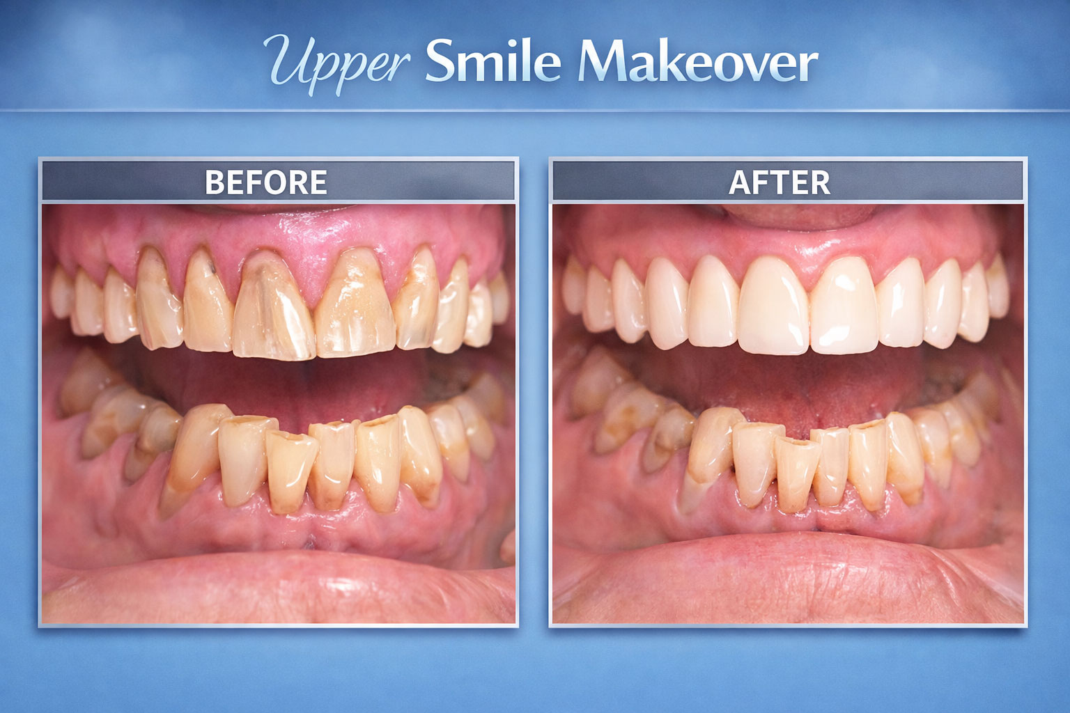 Upper Smile Makeover