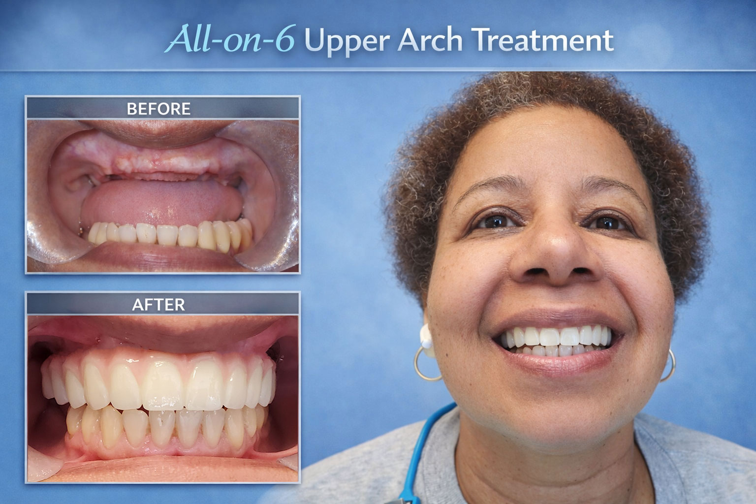 All-On-X Upper Arch Implant