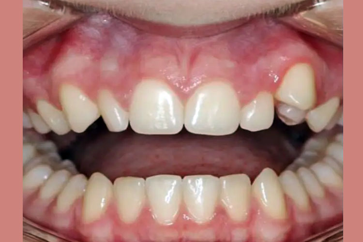 Treatment of Crowded and Rotated Teeth (Invisalign) - Before Image