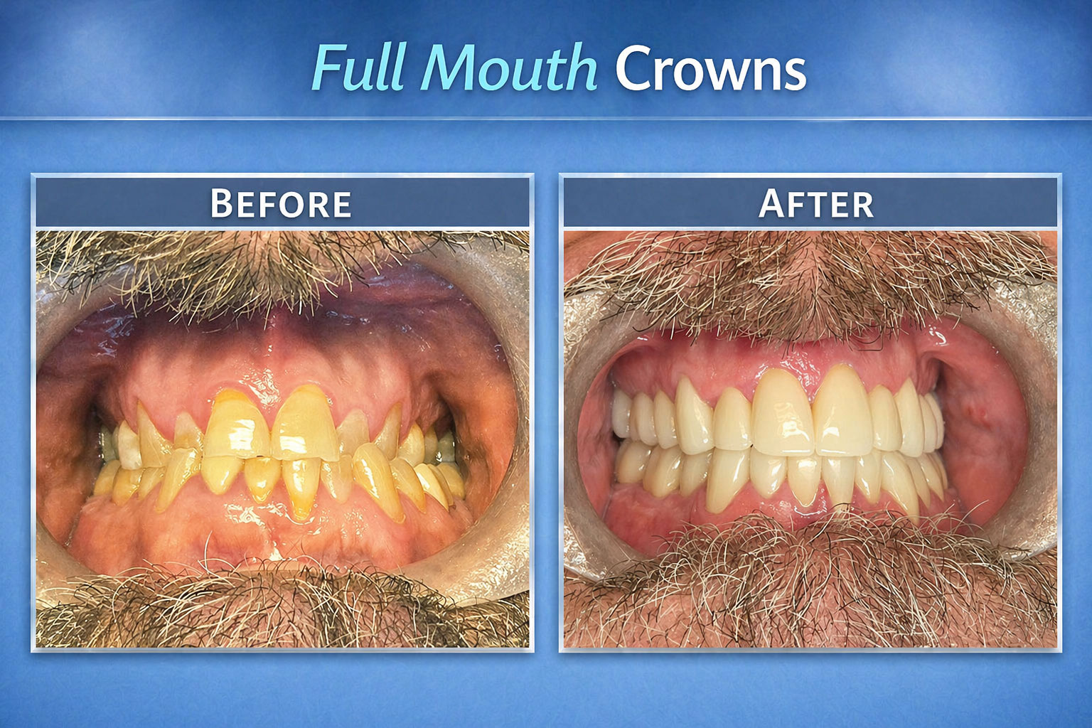 Full Mouth Crown (Before After Image)
