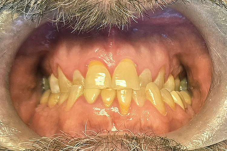 Full Mouth Crowns (Before Image)