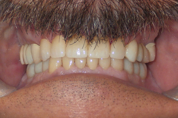 Full Mouth Crowns & Implants Combo - After Image