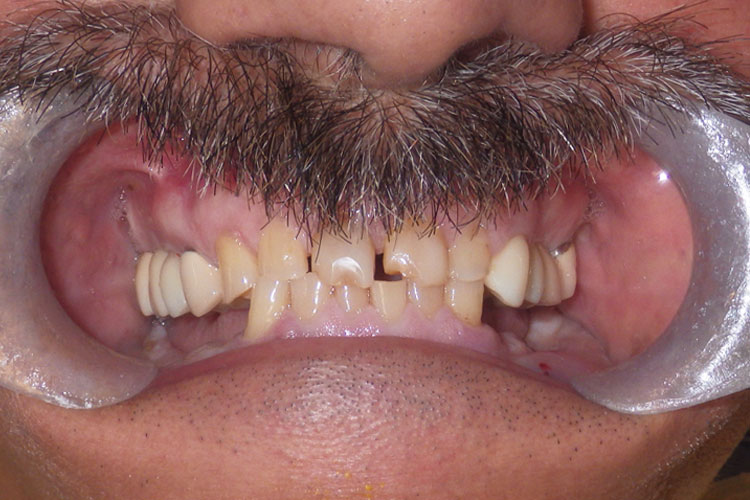 Full Mouth Crowns & Implants Combo - Before Image