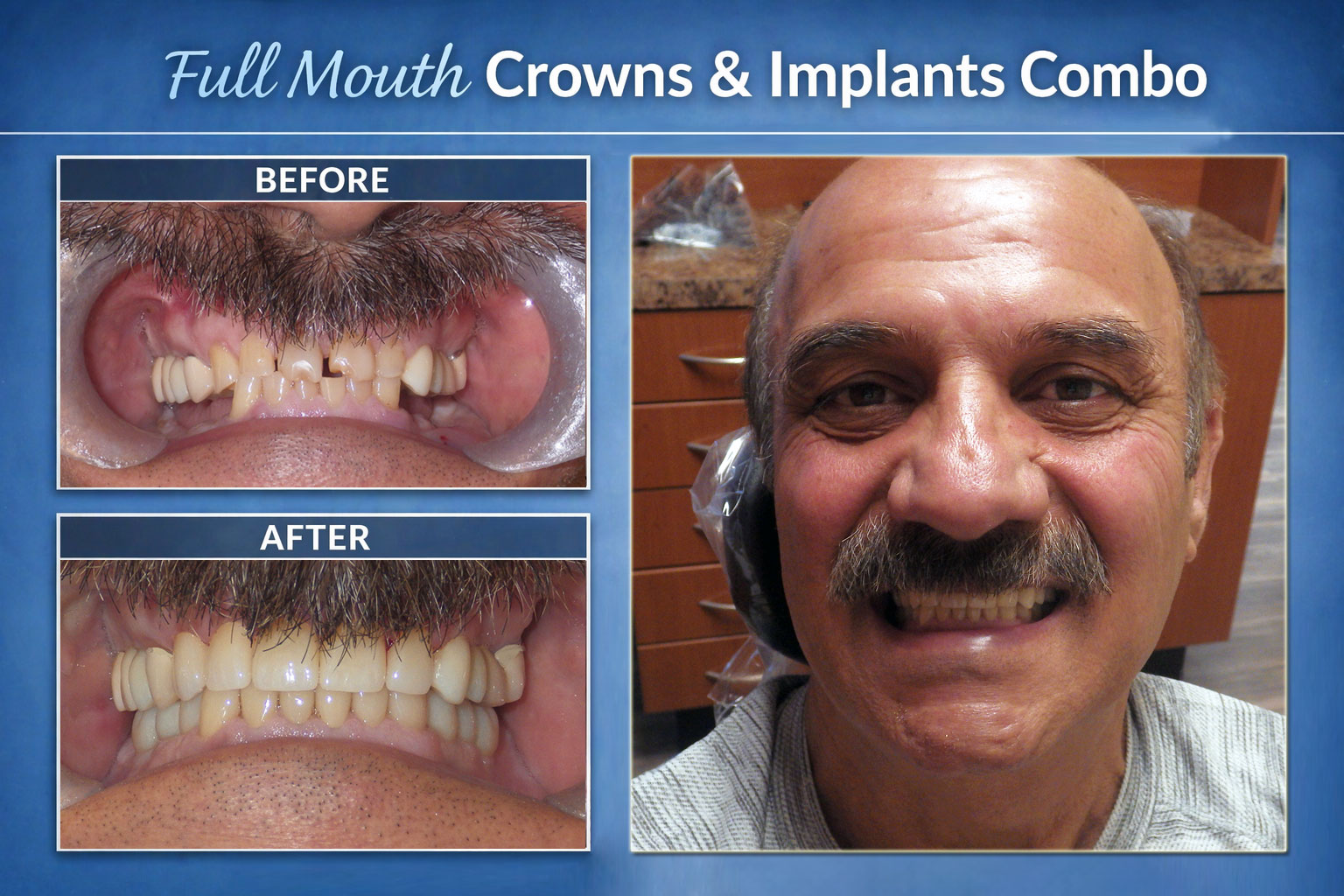 Full Mouth Crowns & Implants Combo (Before - After Image)