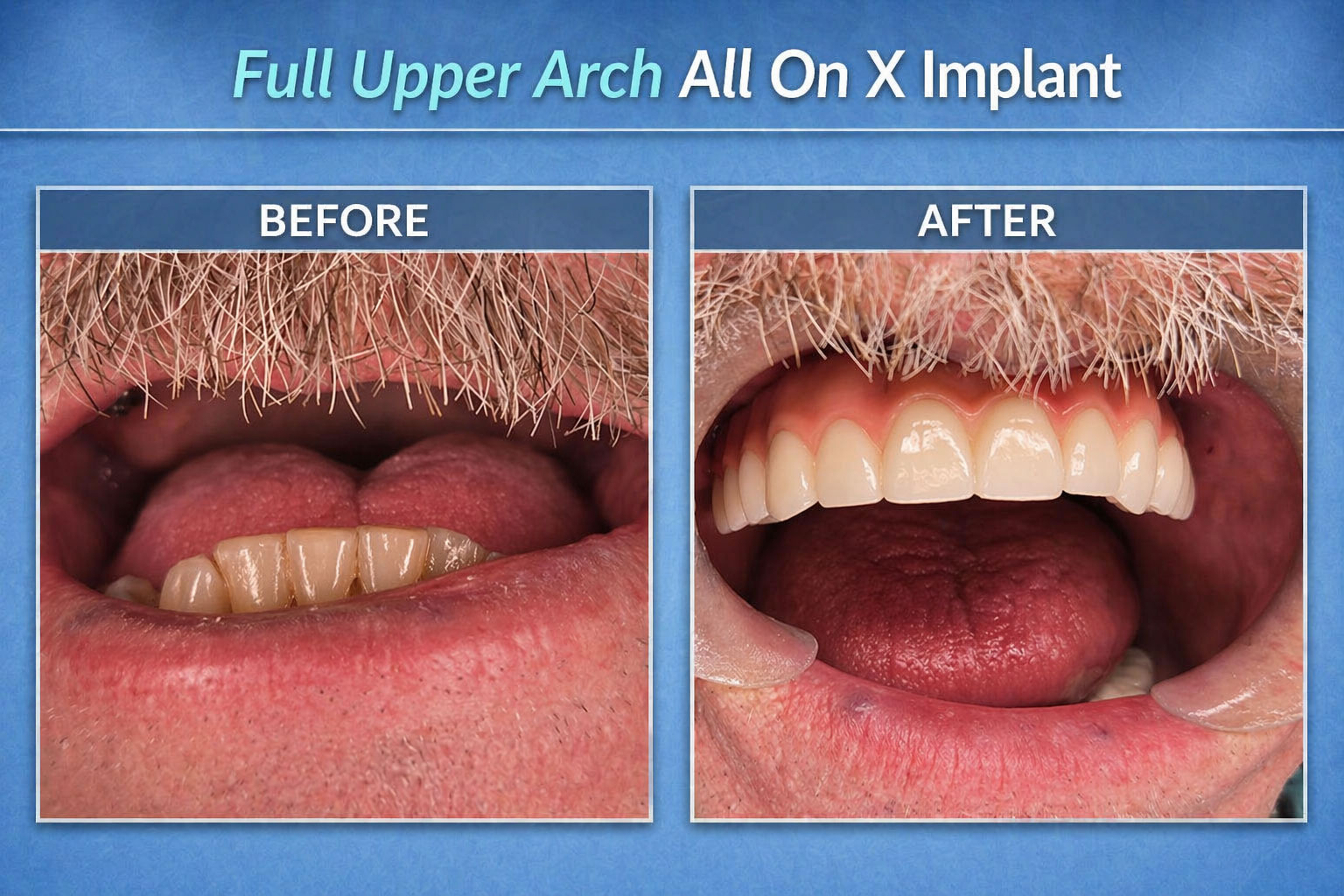 Full Upper Arch All On X Implant (Before - After Image)