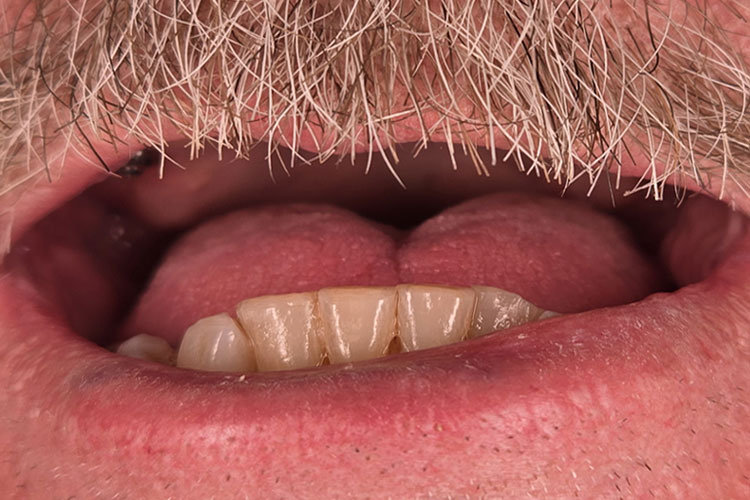 Full Upper Arch All On X Implant (Before Image)