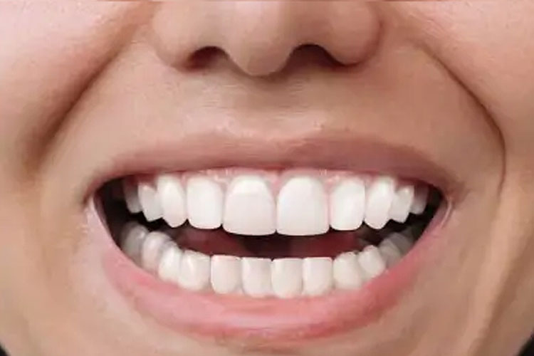 Invisalign Treatment (After Image)