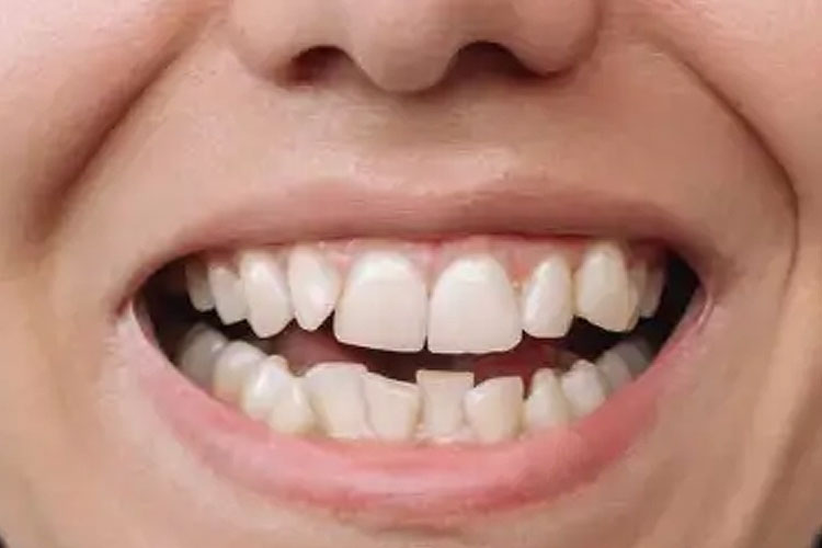 Invisalign Treatment (Before Image)