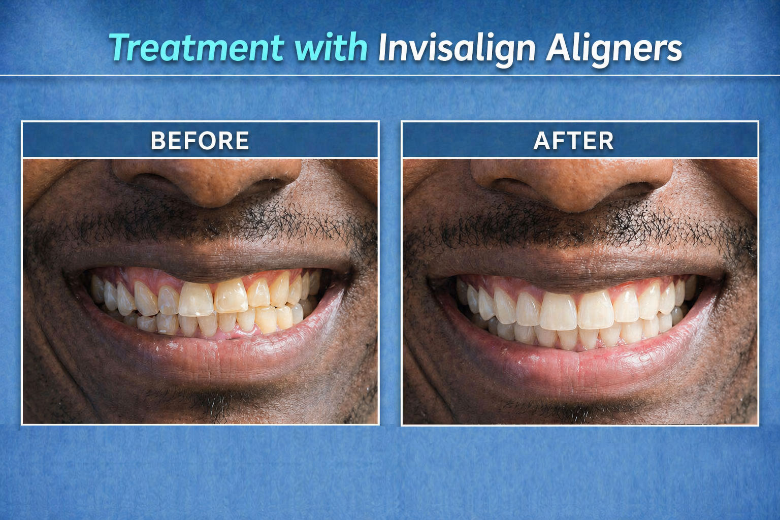Invisalign Treatment (Before After Images)