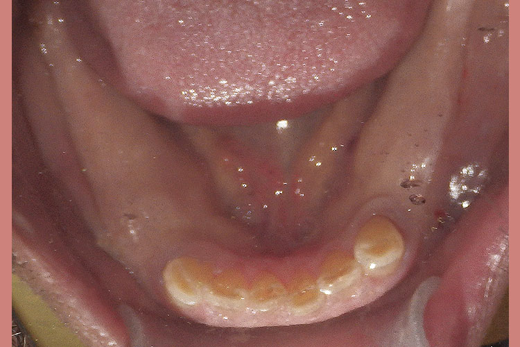 Multiple Implants - Before Image