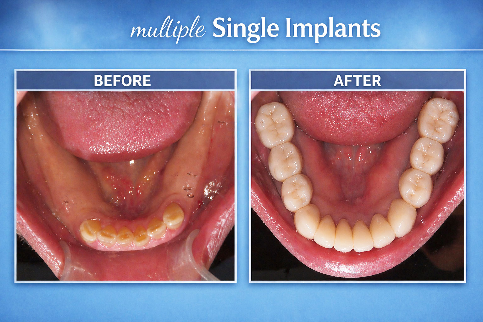 Multiple Single Implants (Before & After Images)