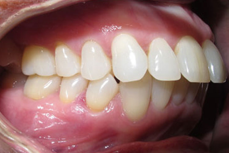 Overbite Treatment (Invisalign) - Before Image