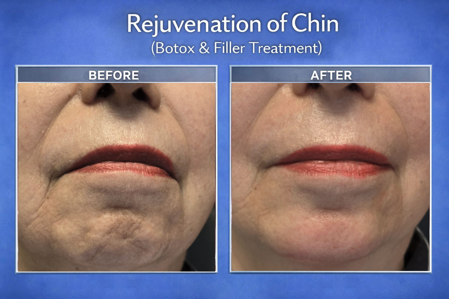 Rejuvenation of Chin