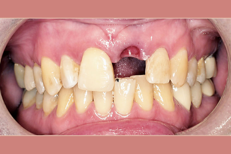 Single Front Tooth Implant - Before Image