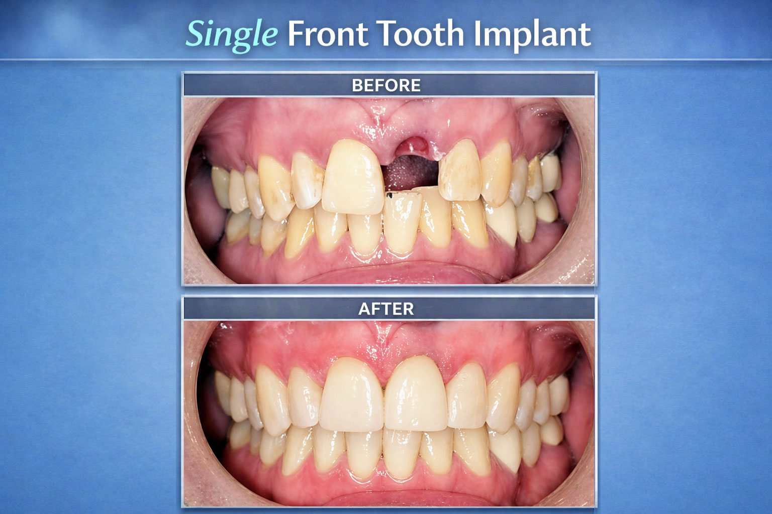 Single Front Tooth Implant (Before - After Image)