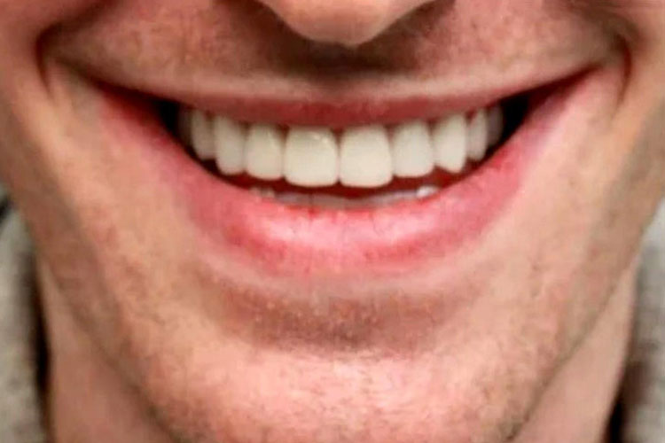 Underbite Treatment (Invisalign) - After Image